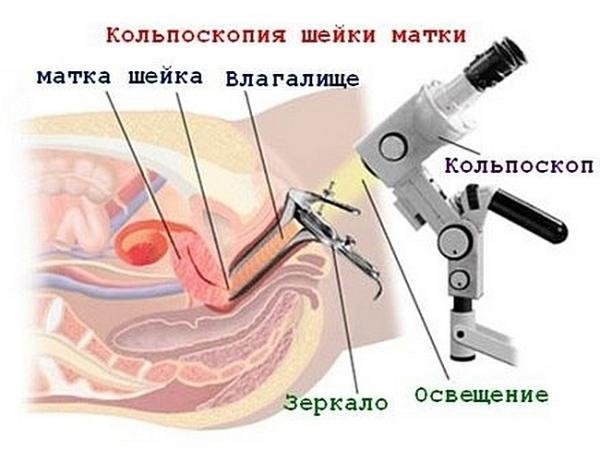 Современная кольпоскопия: быстро, безболезненно, информативно!